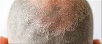 Scalp Sunburn: Not Just the Skin, the Scalp Can Also Suffer
